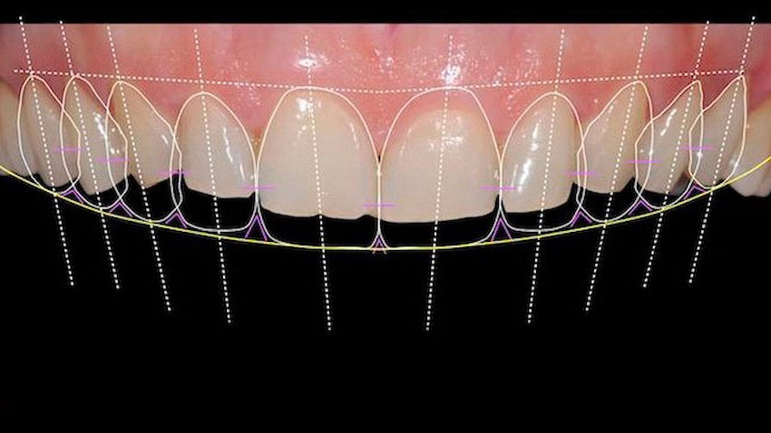 digital smile design