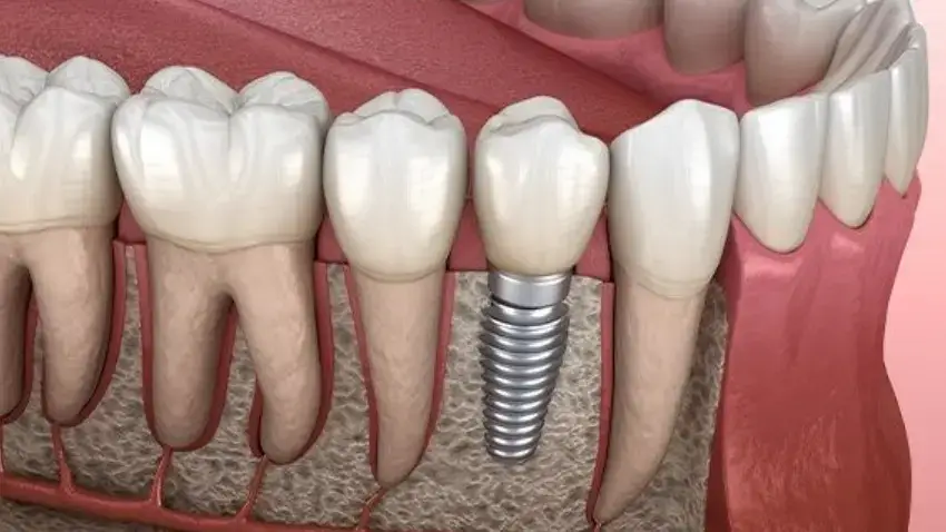implanty dentystyczne