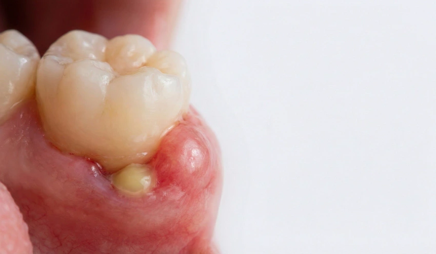 abcese dentare