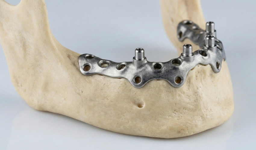 subperiosteal implants in t&uuml;rkiye procedure