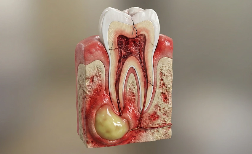 poți chiar să repari un abces dentar