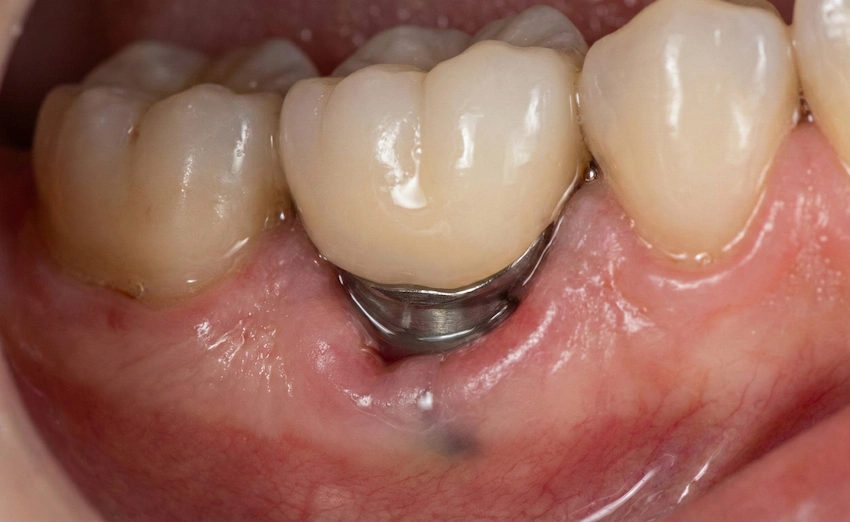 implant gingival recession and bone loss