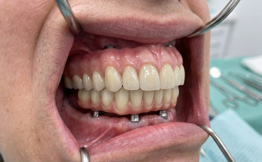 full jaw implant bridges