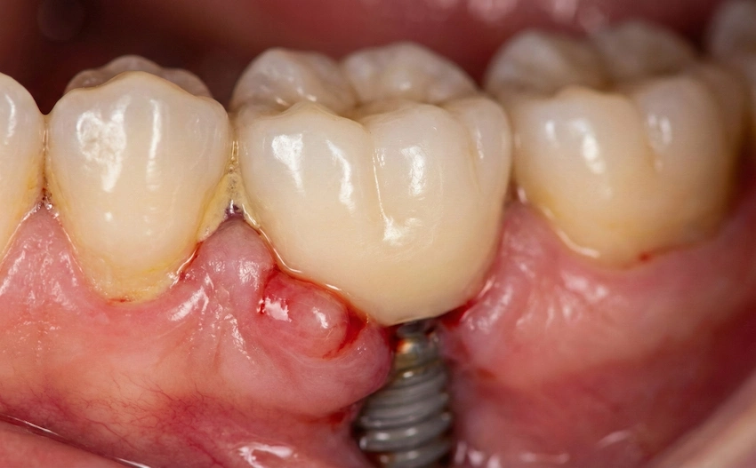 peri implantitis initial symptoms redness