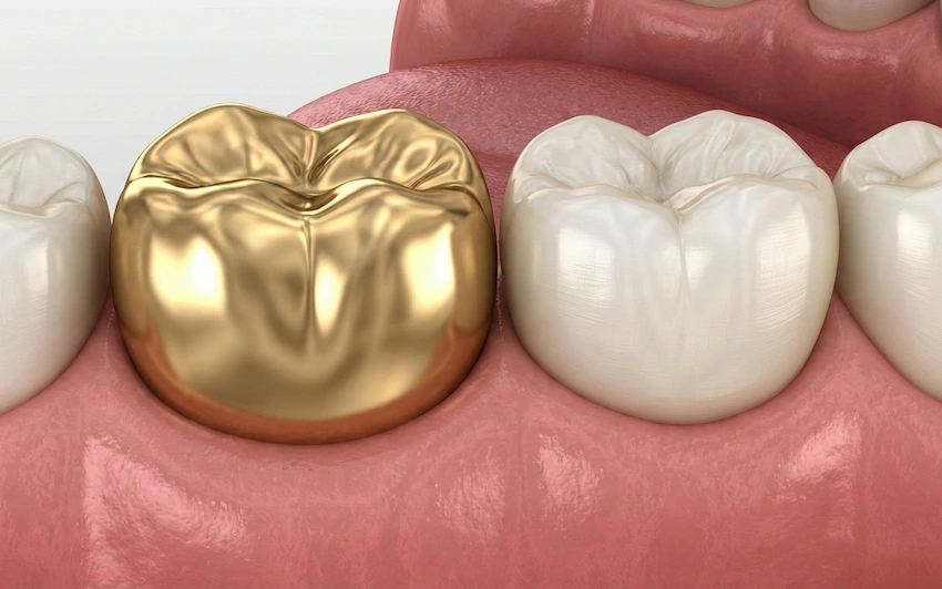 conductividad t&eacute;rmica de los dientes de oro y sensibilidad