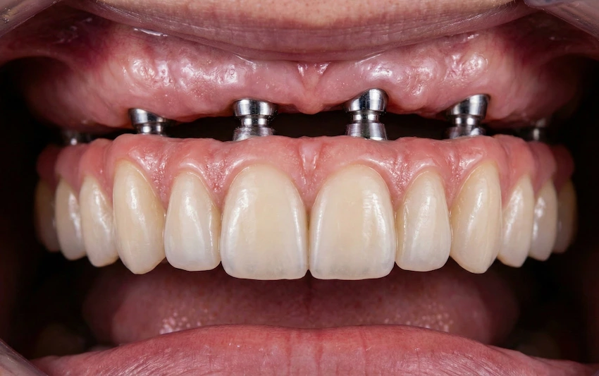 wskaźnik sukcesu dla implantów all on 4