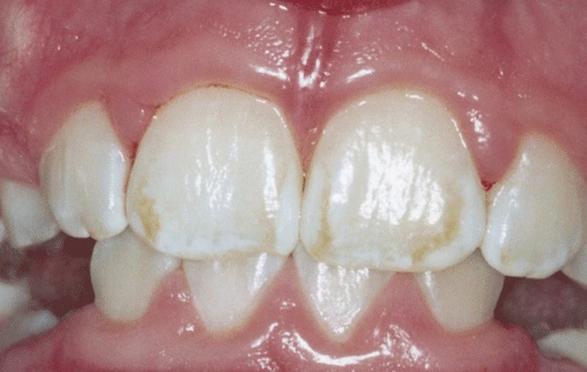 fluoride stains teeth