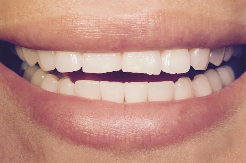 réparation des dents usées