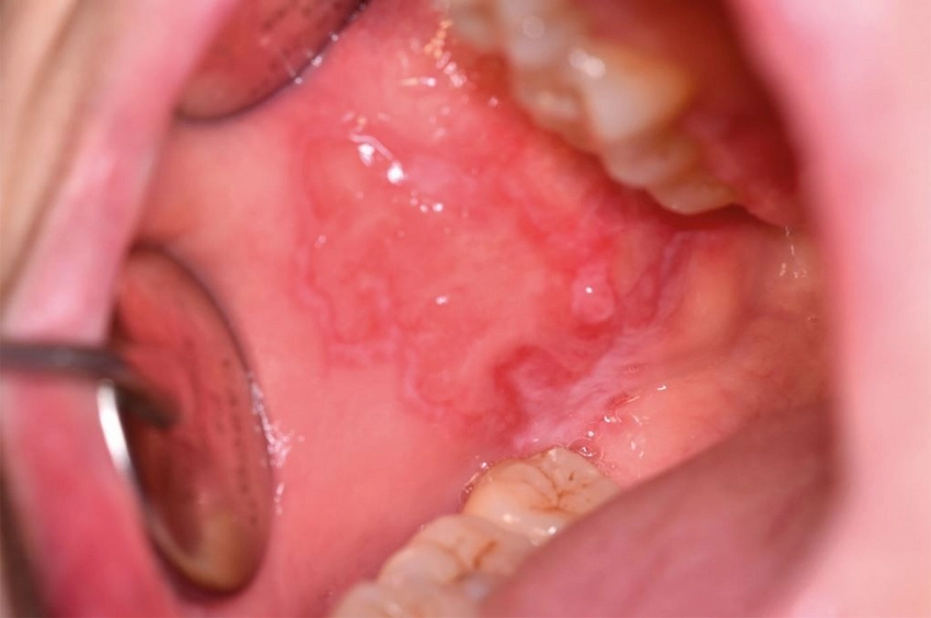 buccal mucosal cancer