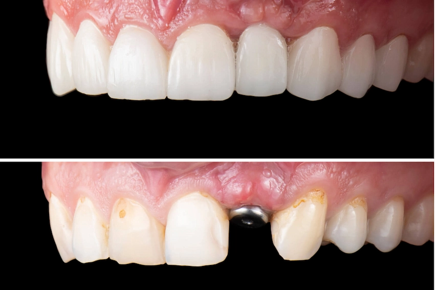 dental implant