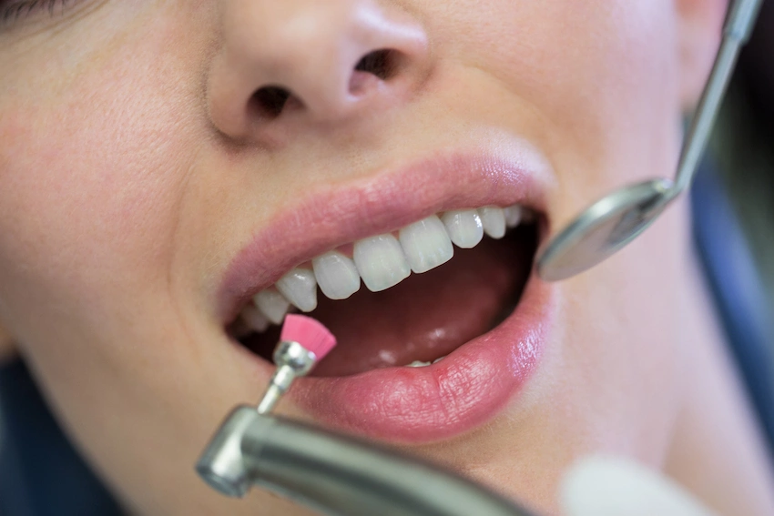 composite-filling