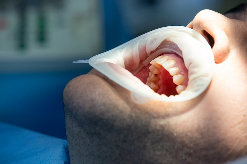 consideraciones despu&eacute;s de un relleno dental