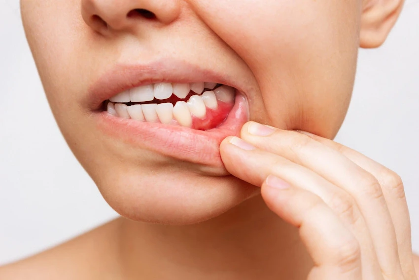 récession gingivale