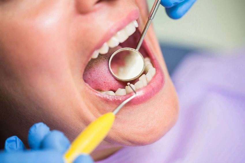 qu&eacute; es un relleno dental
