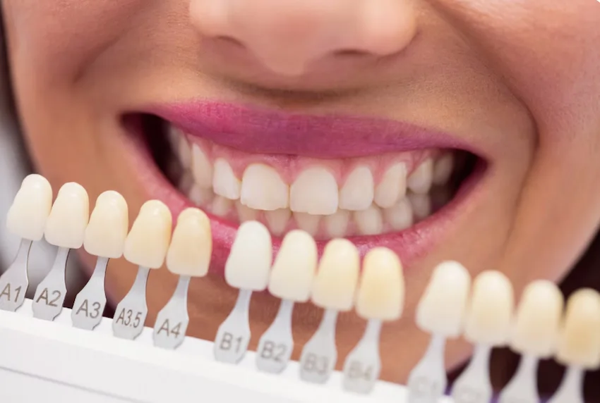 different types of dental veneers