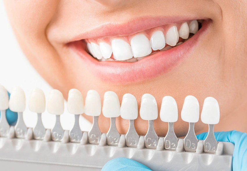 beneficii ale coroanelor dentare