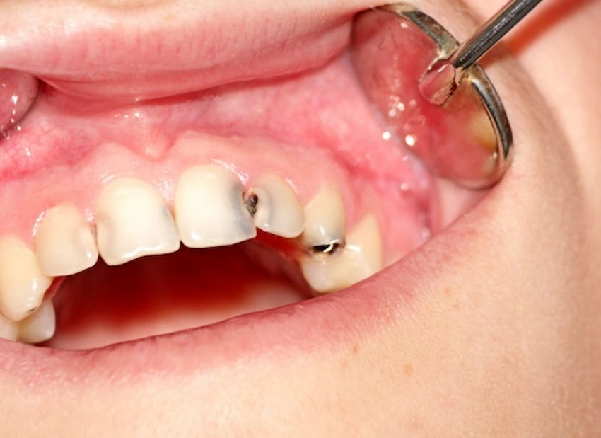 lateral cavities