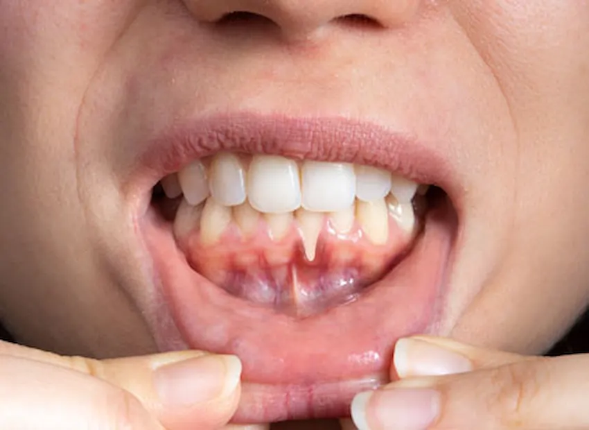 poate dieta obișnuită întări gingiile
