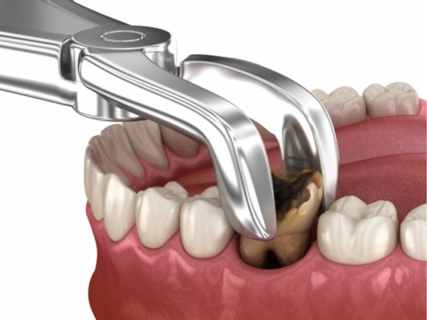 🦷 How Is a Decayed Tooth Root Extraction Done? | LEMA