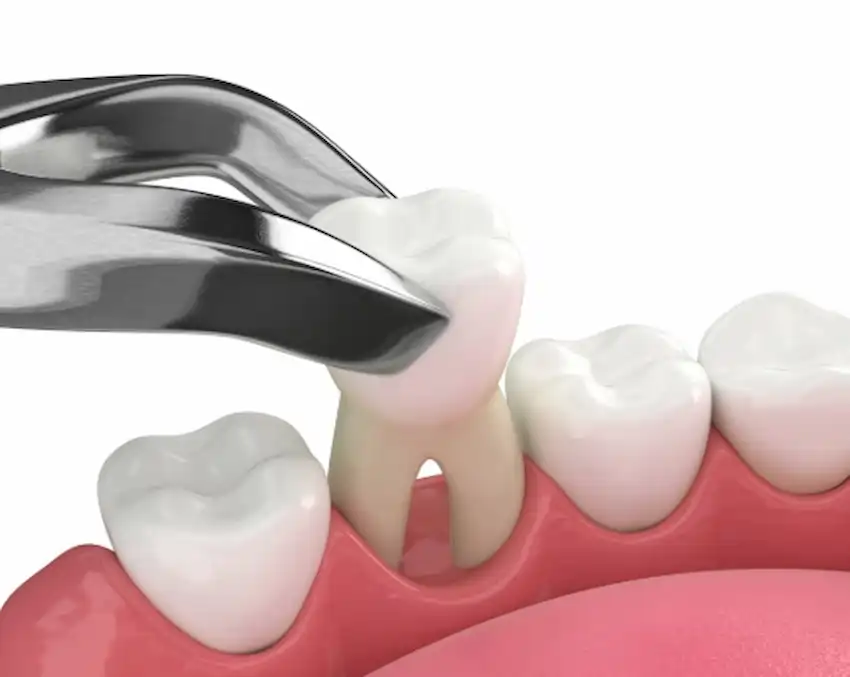 quanto tempo sei malato dopo aver estratto tutti i denti