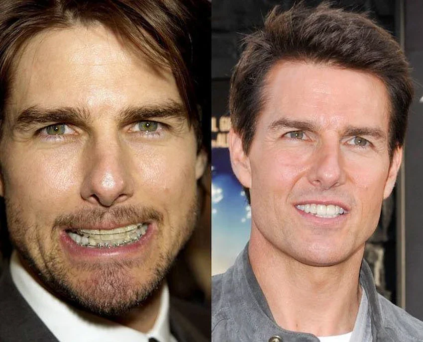 denti di tom cruise dopo