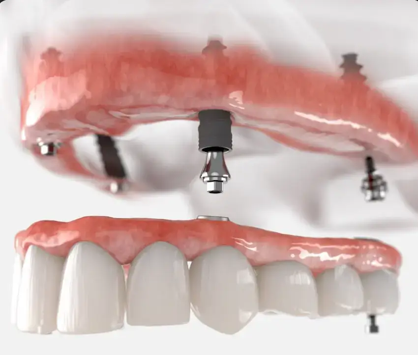 dental implantat versus parkeringsrutor