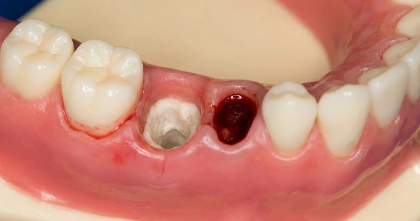 Dry Socket After Tooth Extraction Causes And Prevention LEMA dry-socket-after-tooth-extraction-causes-and-prevention-lema