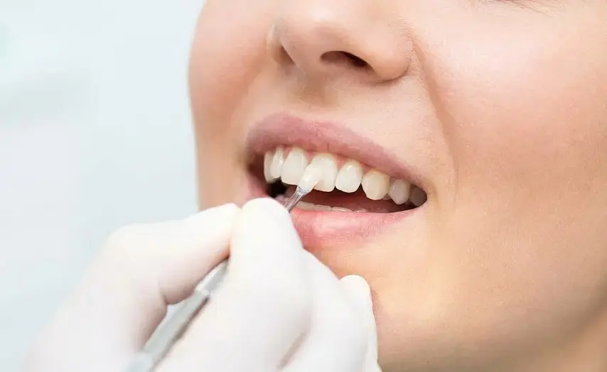 dental bonding fix crooked teeth