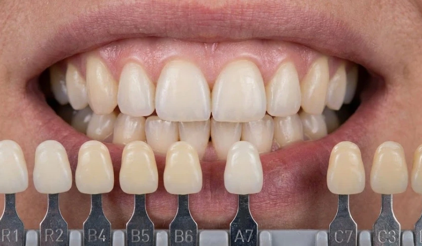 natural-tooth-vs-crown-color