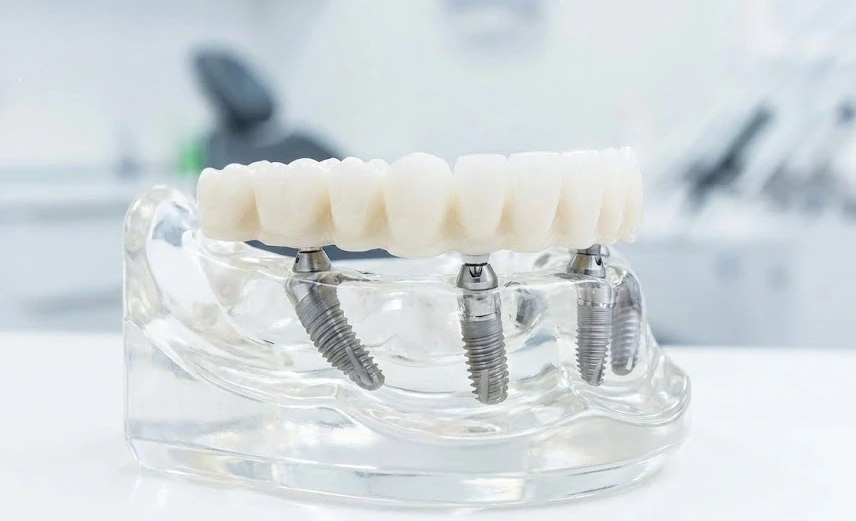 all on 4 implantatmodel demonstration