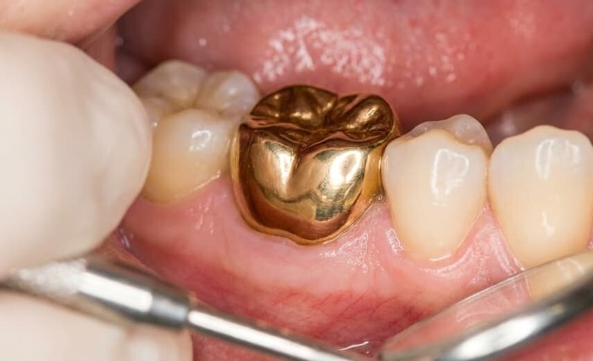 expertly-placed-permanent-gold-tooth