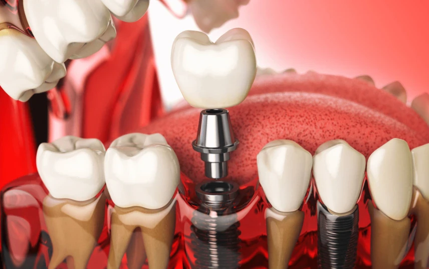 d6080-dental-code-description