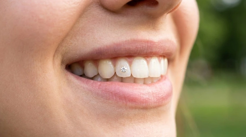 sparkling-tooth-gem-result