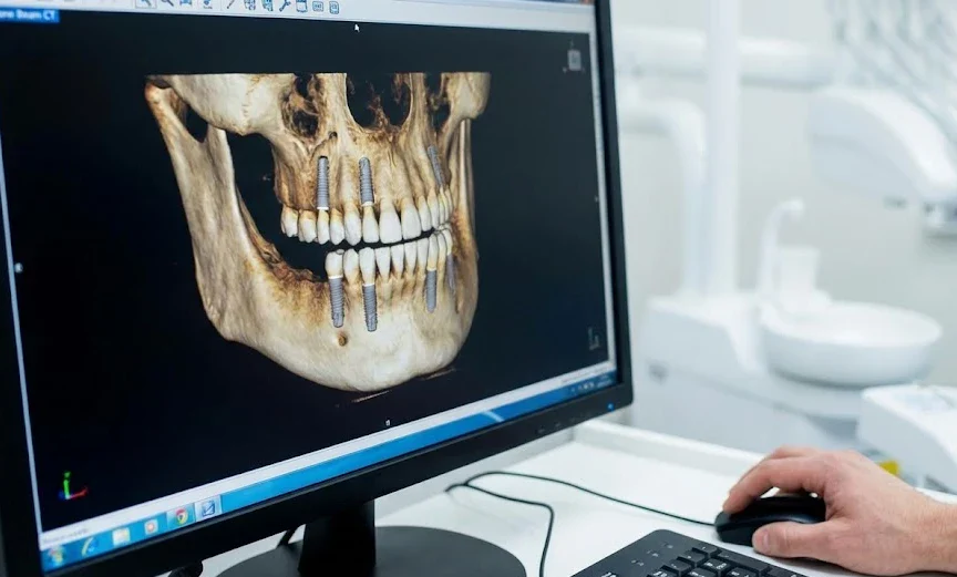 fortschrittliche 3D-digitaler Implantationsplan