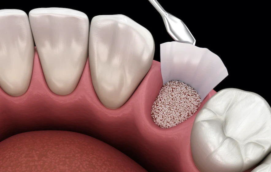 ridge-preservation-d4265-bone-graft-procedure