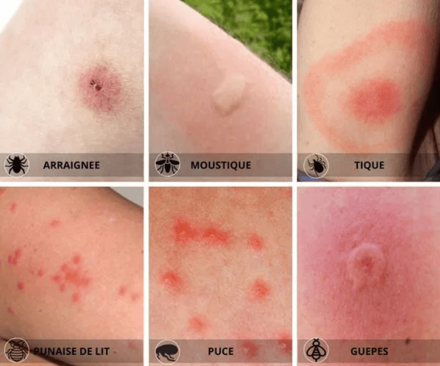 image 10 - Piqure de punaise de lit: le guide ultime !