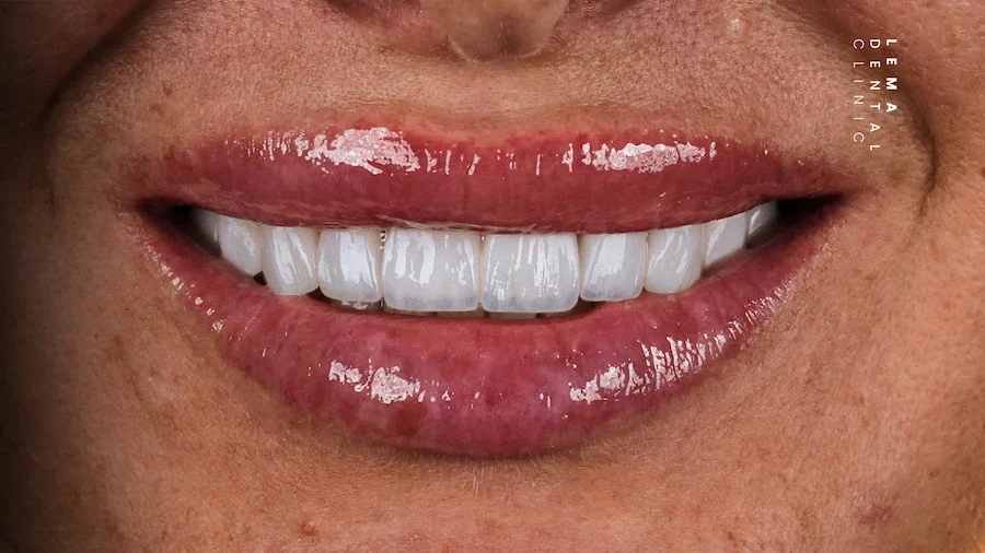 hollywood smile after photo lema dental clinic 3