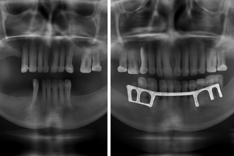x-ray endostealinių ir subperiostealinių implantų