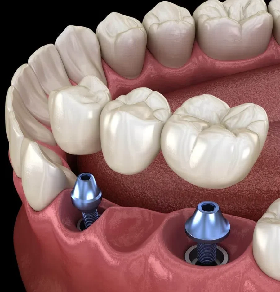 d6245​&zwj;​&zwnj;&zwj;​&zwj;&zwnj;​&zwj;​&zwnj;&zwj;​&zwj;&zwnj;-dental-code-implant-supported-ceramic-pontic