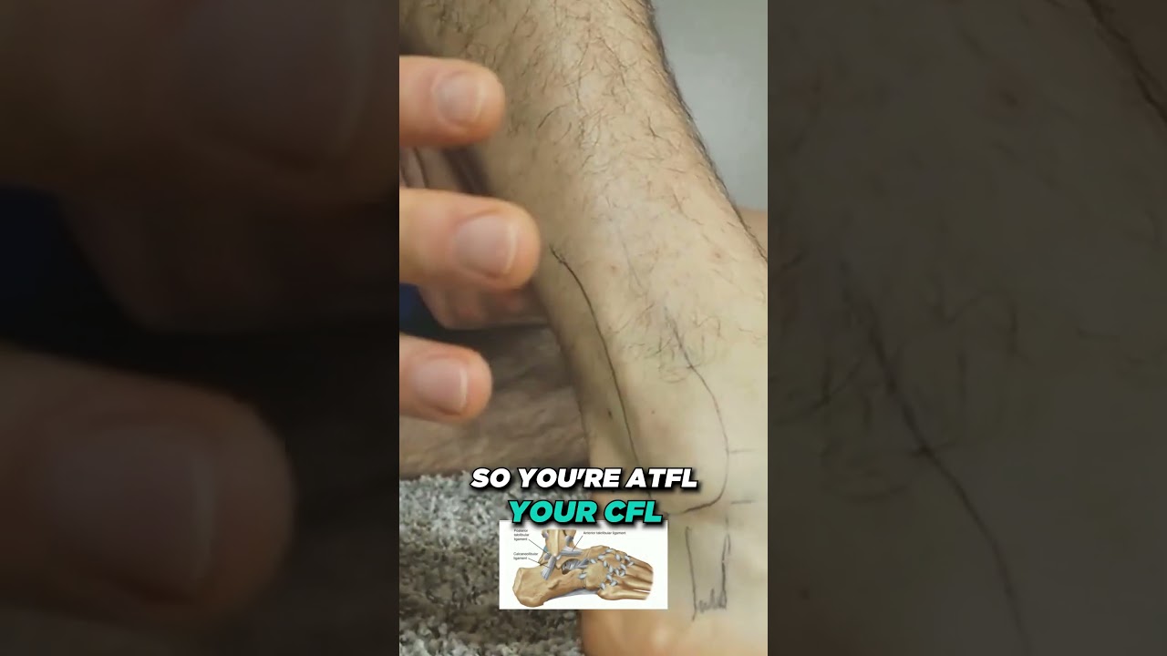 What is a SPRAINED ANKLE? [How Long can a sprained ankle last?]