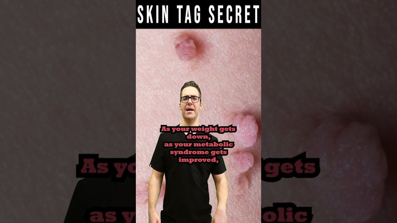 How To FIX Skin Tags FOREVER! 2 How To FIX Skin Tags FOREVER!