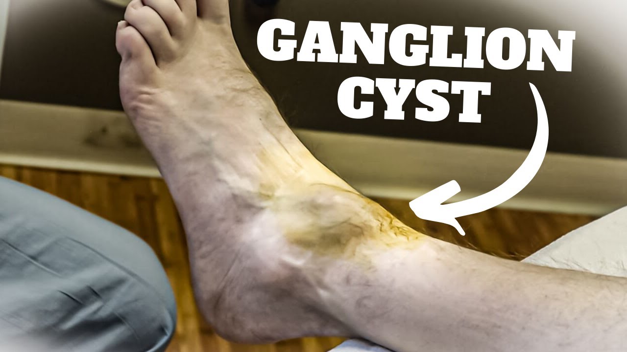 Aspiration of a Ganglion Cyst Procedure and Recovery Time 2 HUGE Ankle Ganglion Cyst Aspiration Surgery - *Foot & Ankle Treatment*