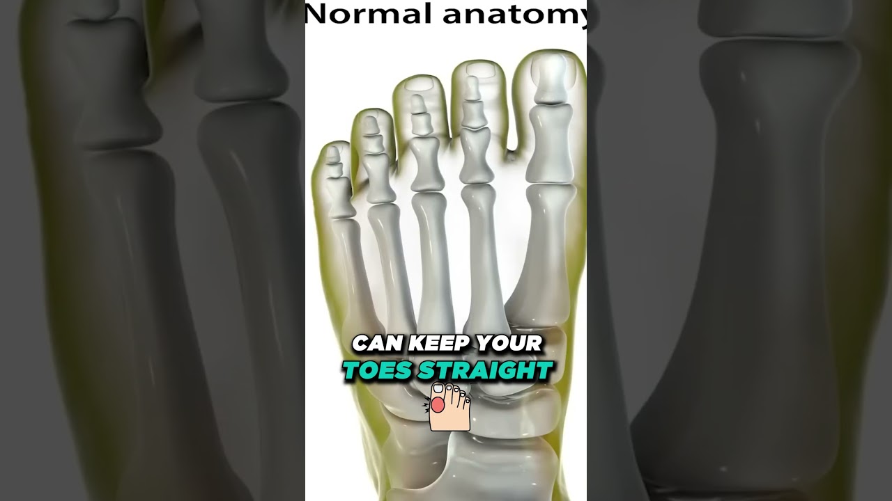 What is a Bunion? [What causes bunions & How to get rid of bunions!]