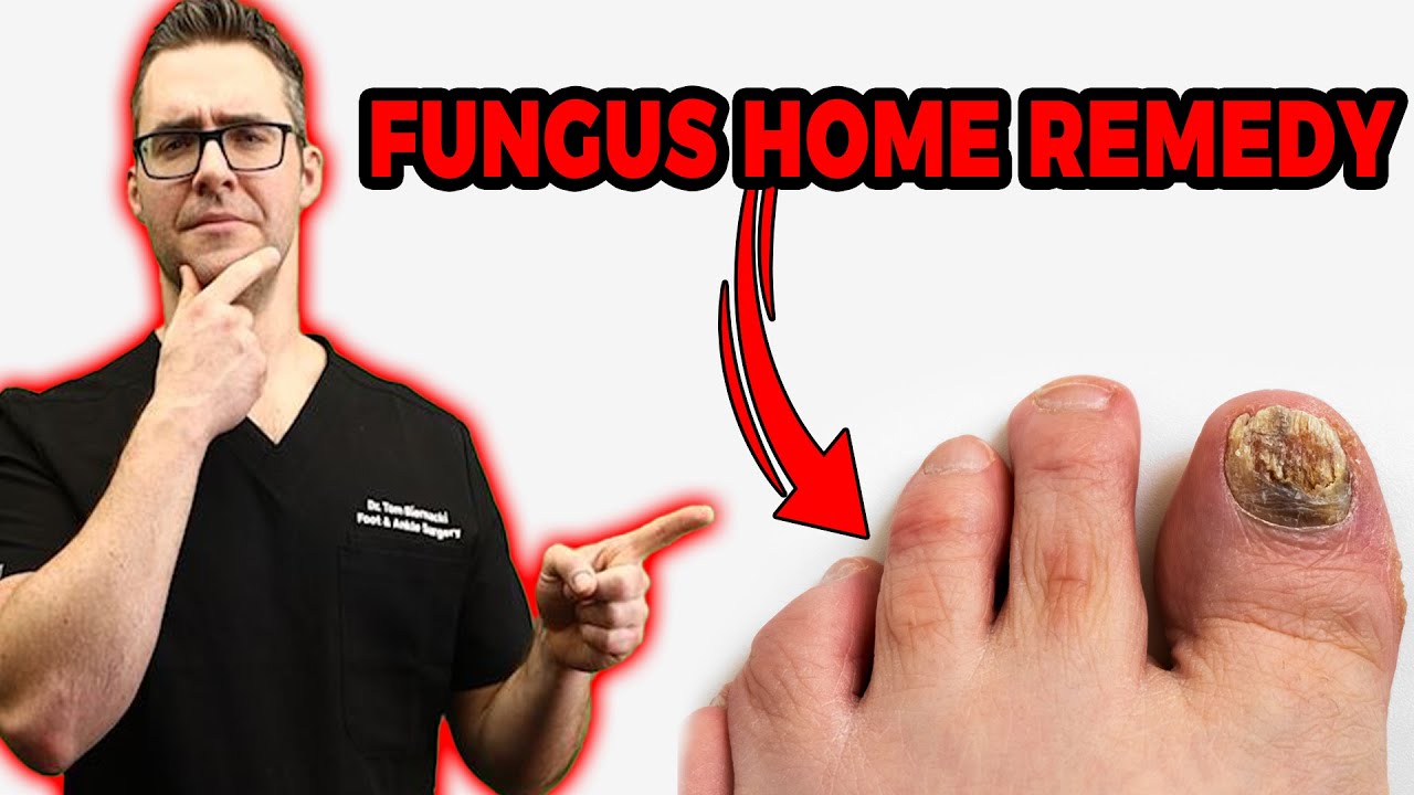 20 Ways To Get Rid of Toenail Fungus (Proven CURE & Home Remedies)