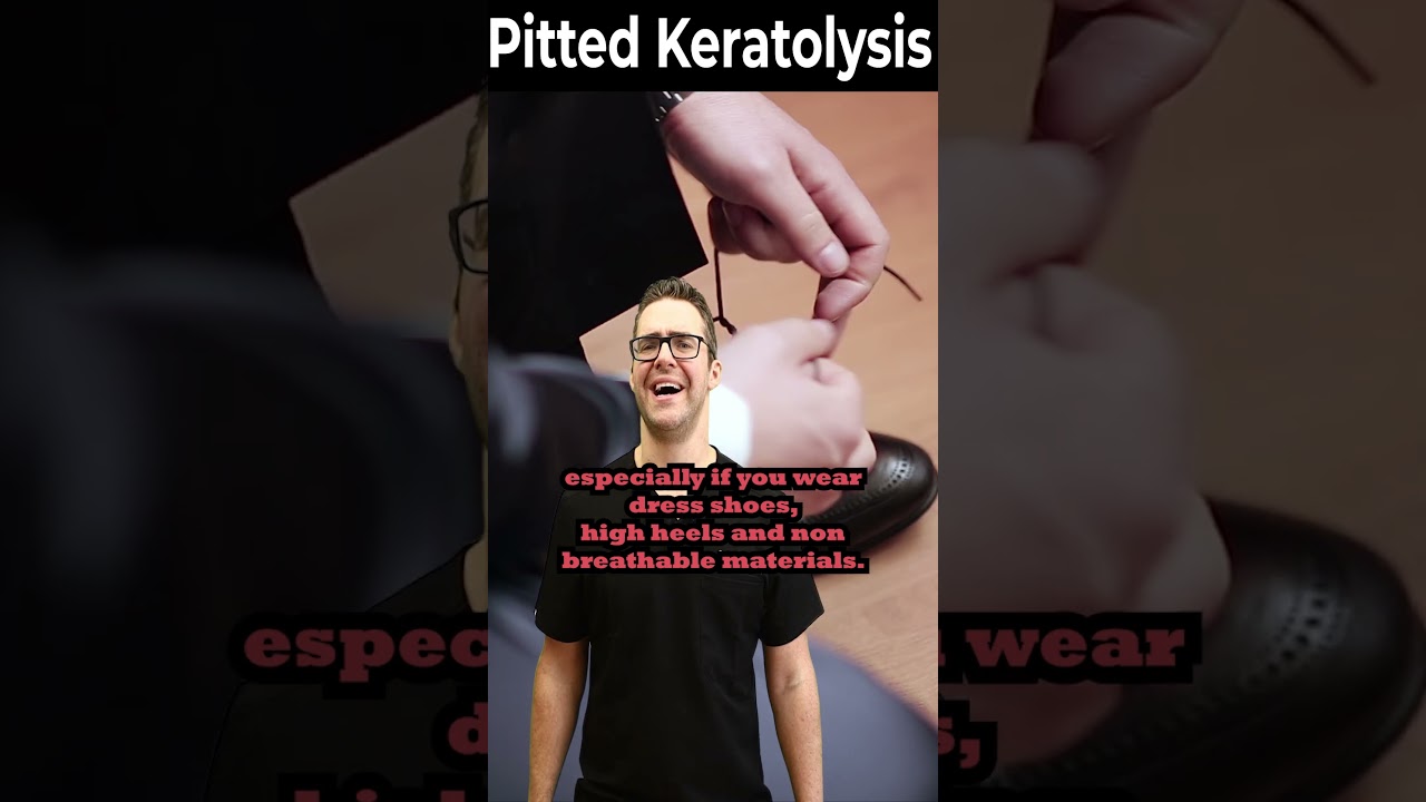How To Get Rid of Pitted Keratolysis ONCE & FOR ALL! 2 How To Get Rid of Pitted Keratolysis ONCE & FOR ALL!