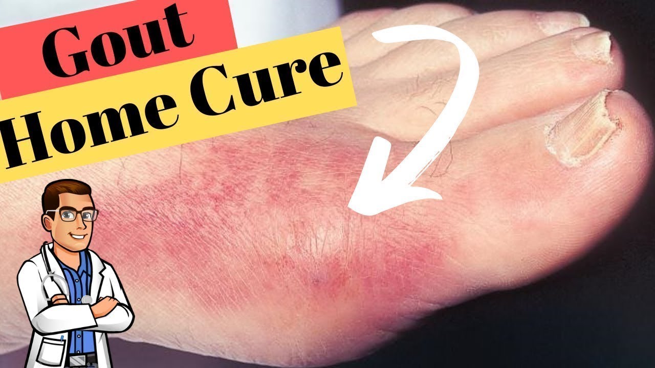 Gout Big Toe Joint Treatment [BEST Home Remedies]