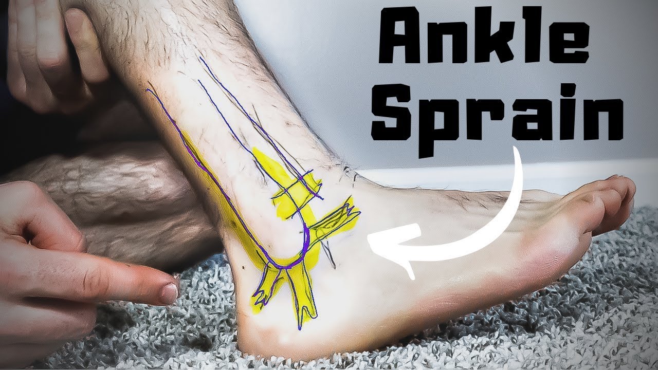 Tendons In Ankle 1 Twisted or Rolled Ankle Sprain Treatment: FASTER Home Recovery Time!