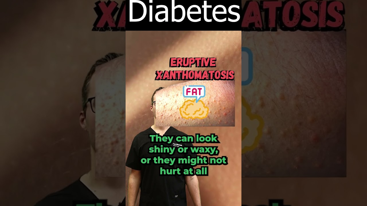 Eruptive Xanthomatosis Pictures & Treatment [Diabetes & Diagnosis]