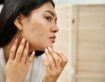 Best Acne Scar Treatment in Brisbane: Achieve Smoother Skin