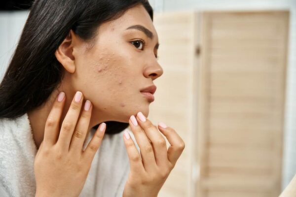 a lady who needs a acne scar treatment
